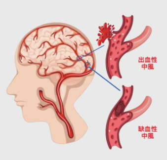 关于脑中风前兆讲解  